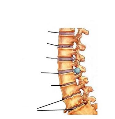 Osteokondroosi arenguetapid