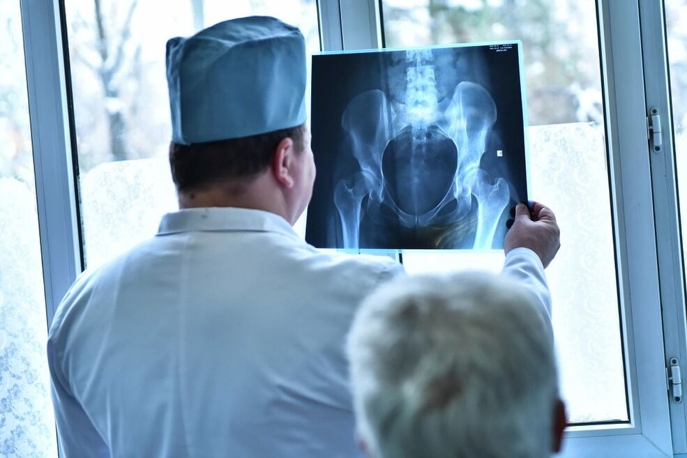 Arst vaatab pilti artroosiga puusaliigesest